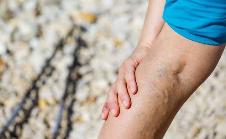 Vein varicose veins